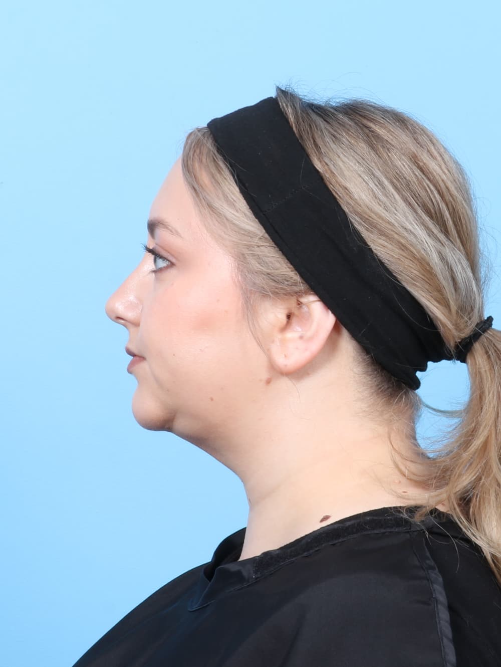 Facial Liposuction case #7686 after, image 3