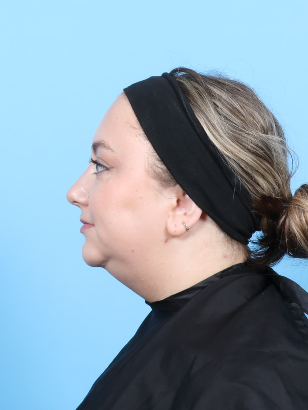 Facial Liposuction case #7686 before, image 3