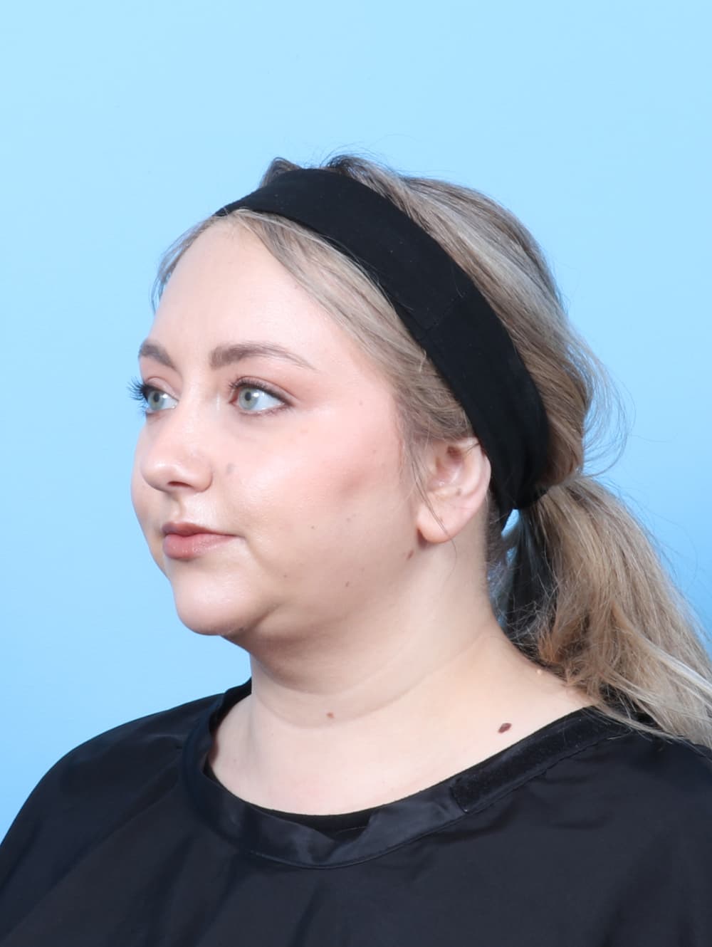 Facial Liposuction case #7686 after, image 2