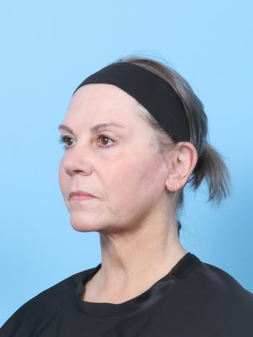 Facelift case #8394 after, image 4
