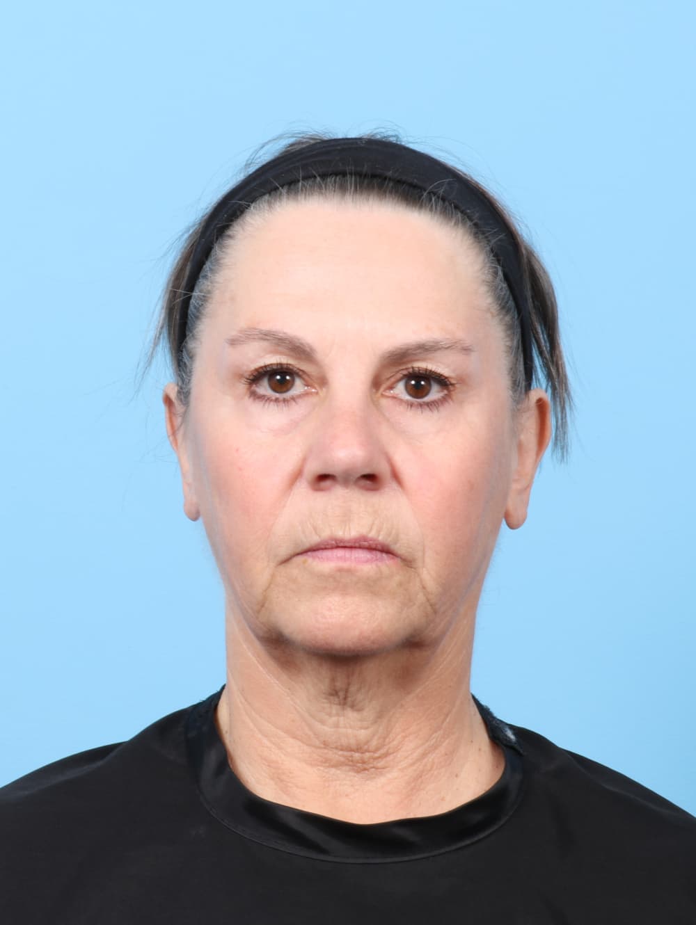 Facelift case #8394 before, image 1