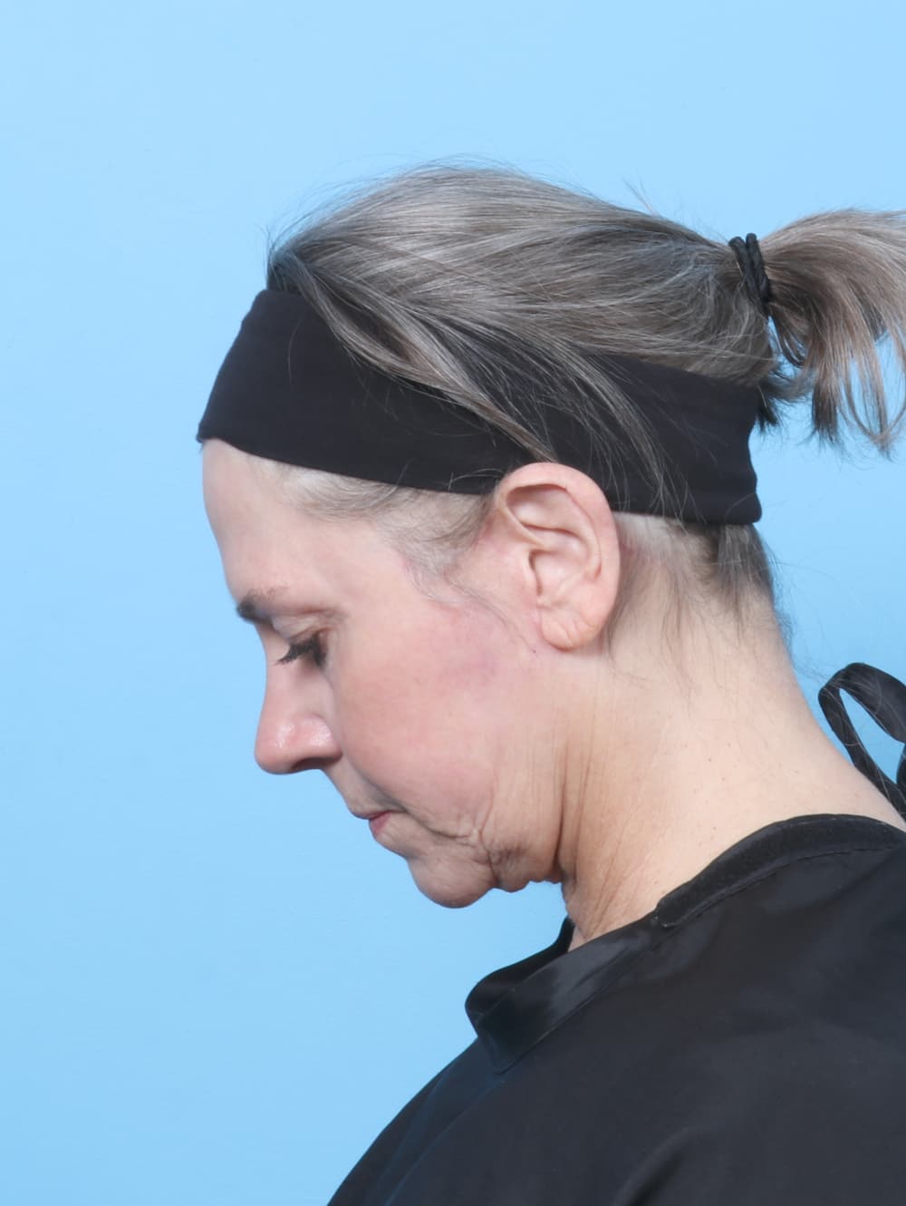 Facelift case #8394 after, image 2