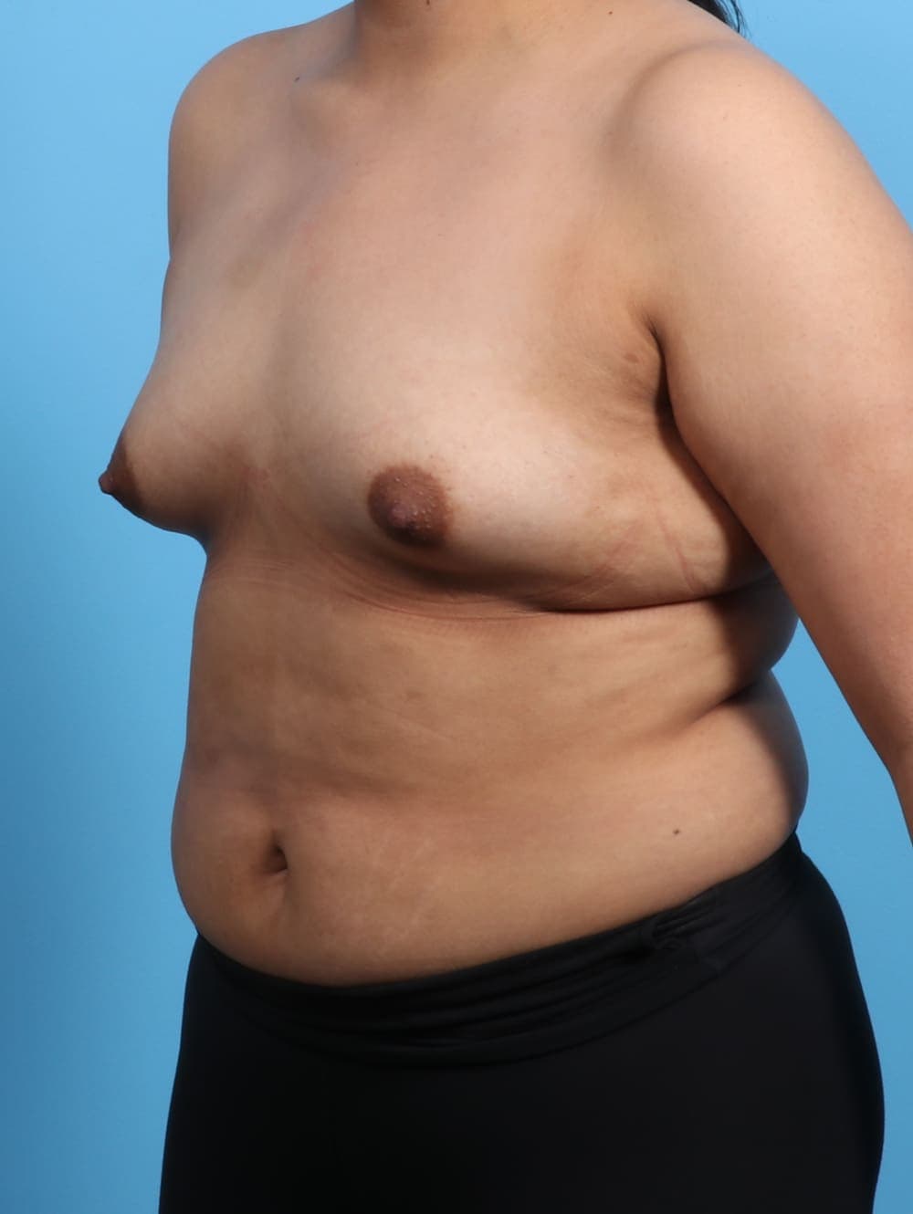 Breast Augmentation case #3203 before, image 2