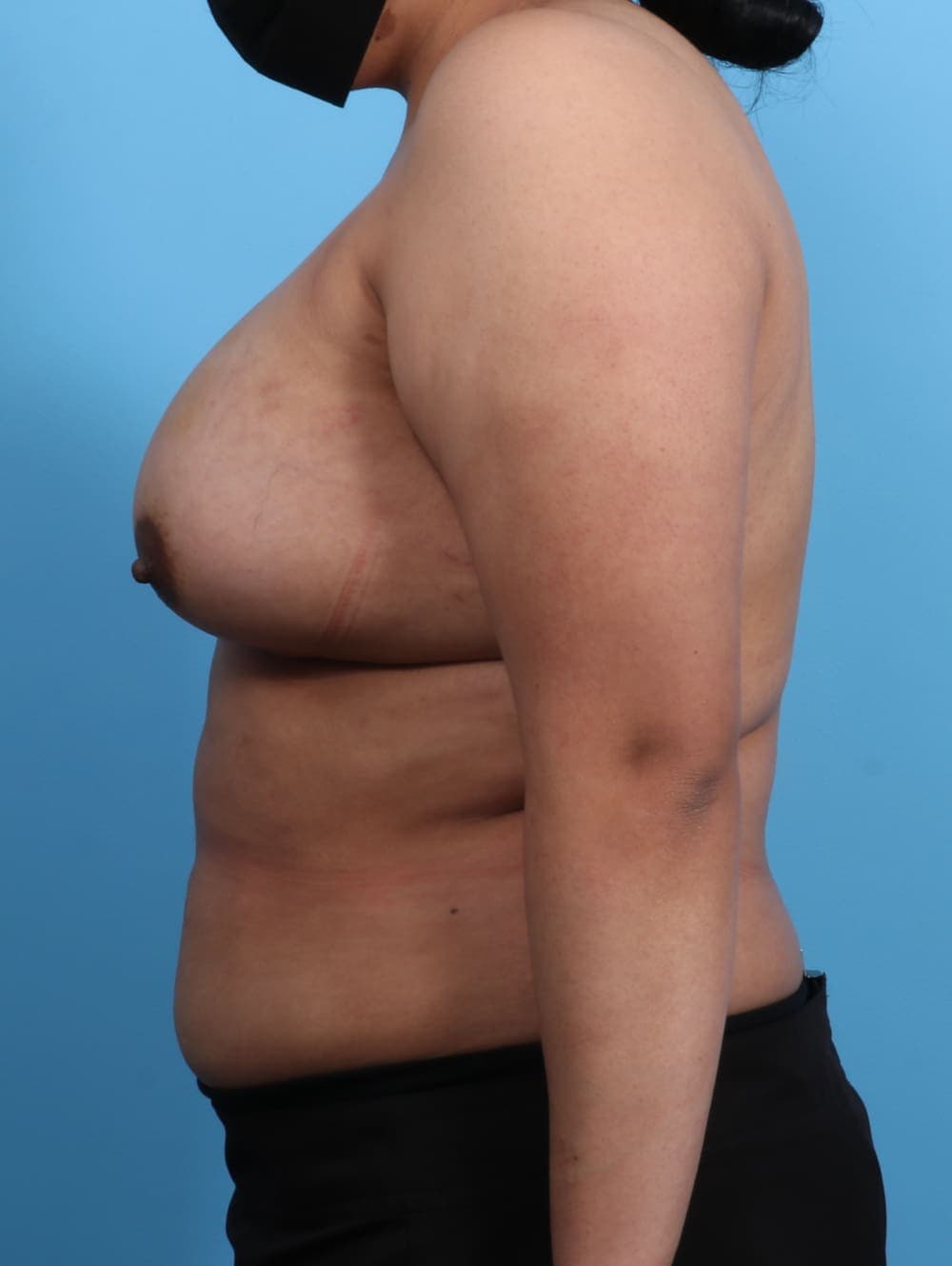 Breast Augmentation case #3203 after, image 3