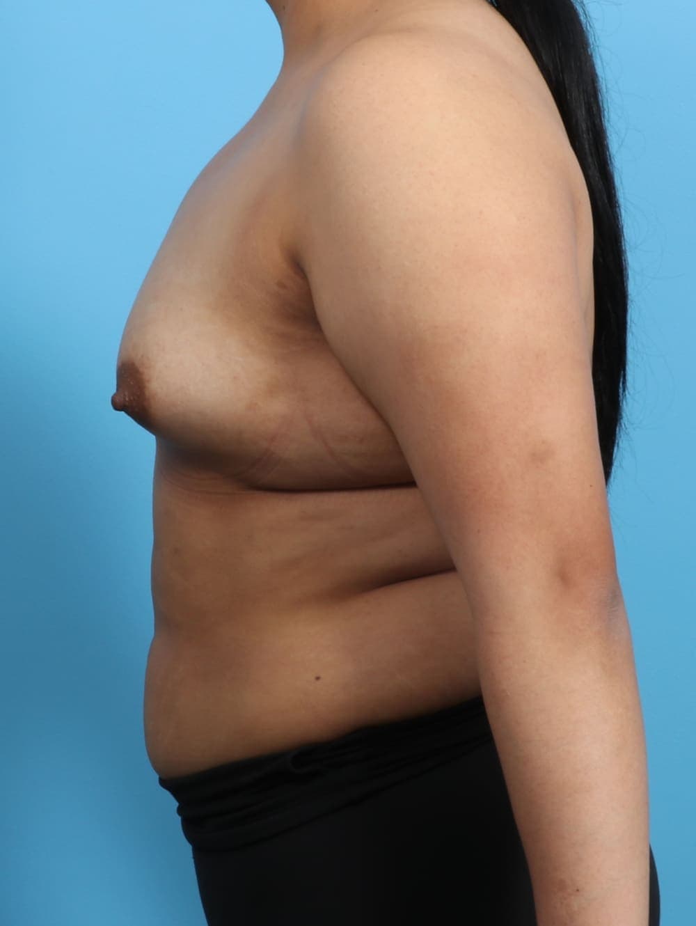 Breast Augmentation case #3203 before, image 3