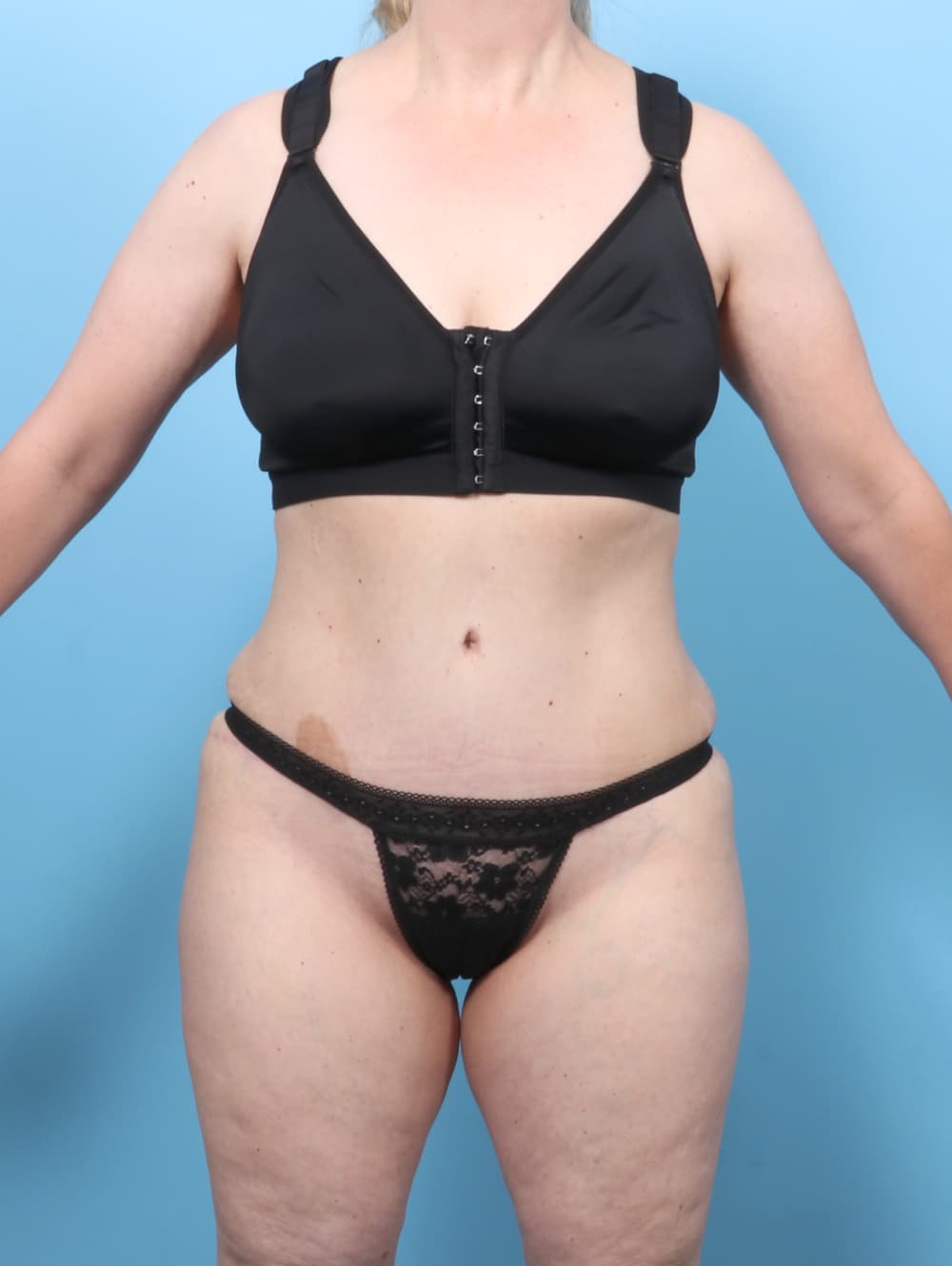 Tummy Tuck case #8634 after, image 1