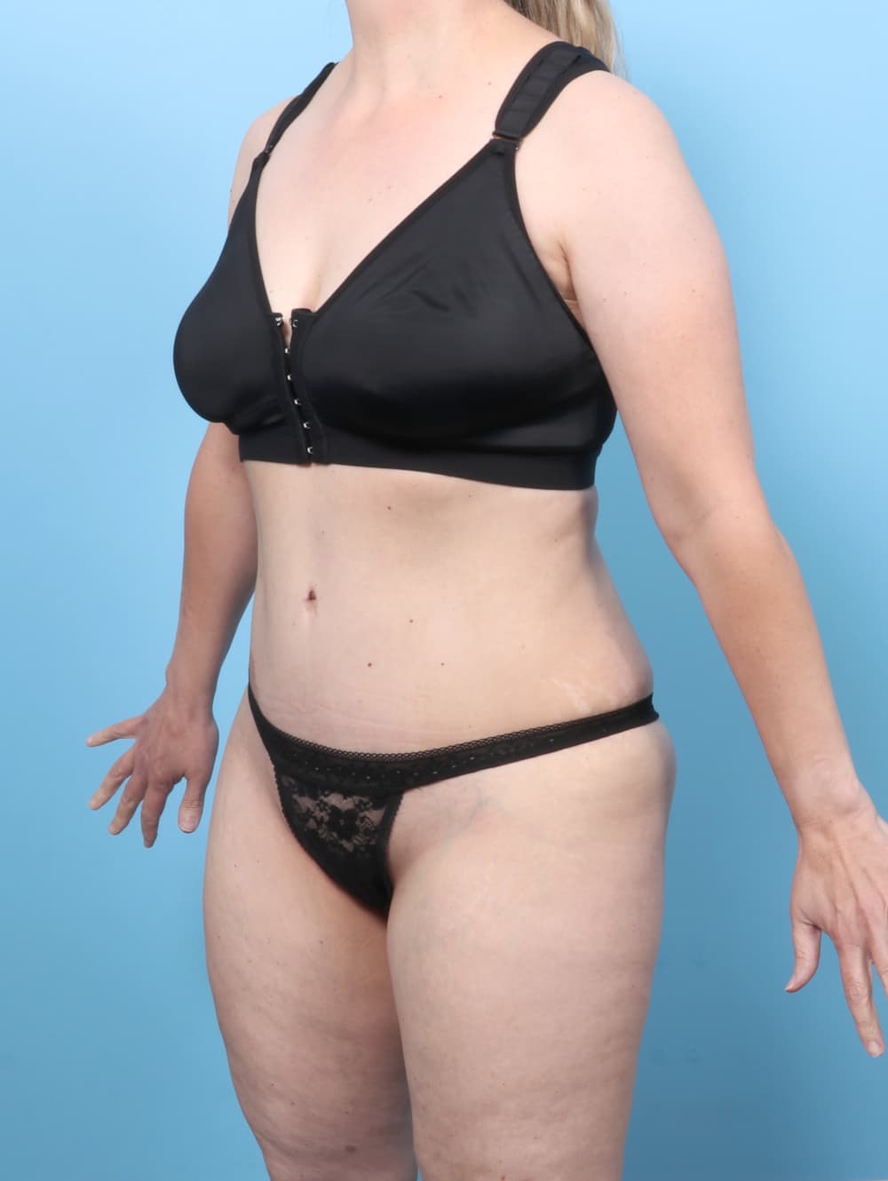 Tummy Tuck case #8634 after, image 2
