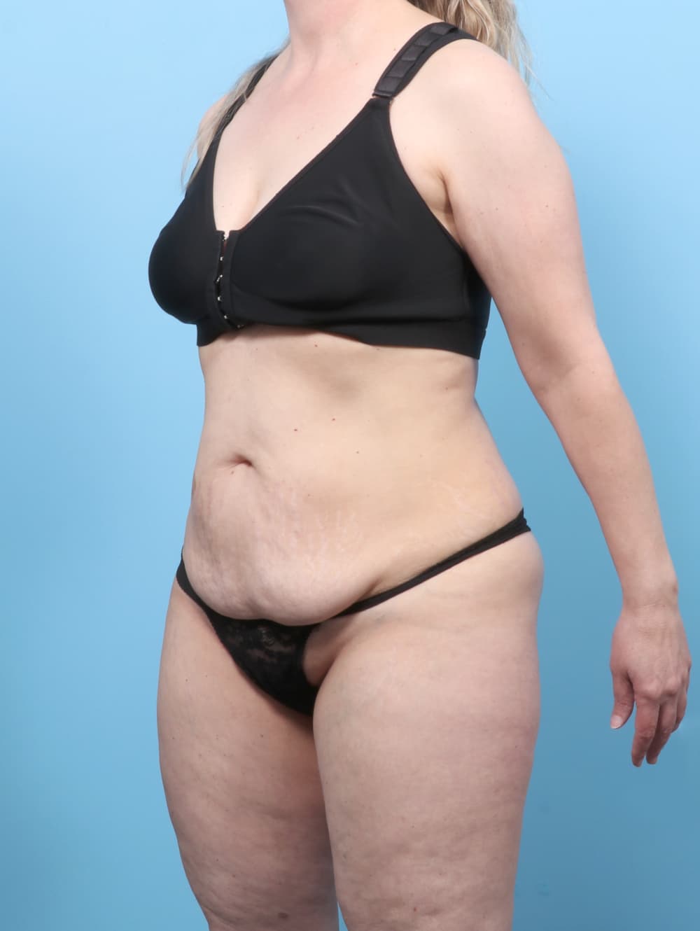 Tummy Tuck case #8634 before, image 2