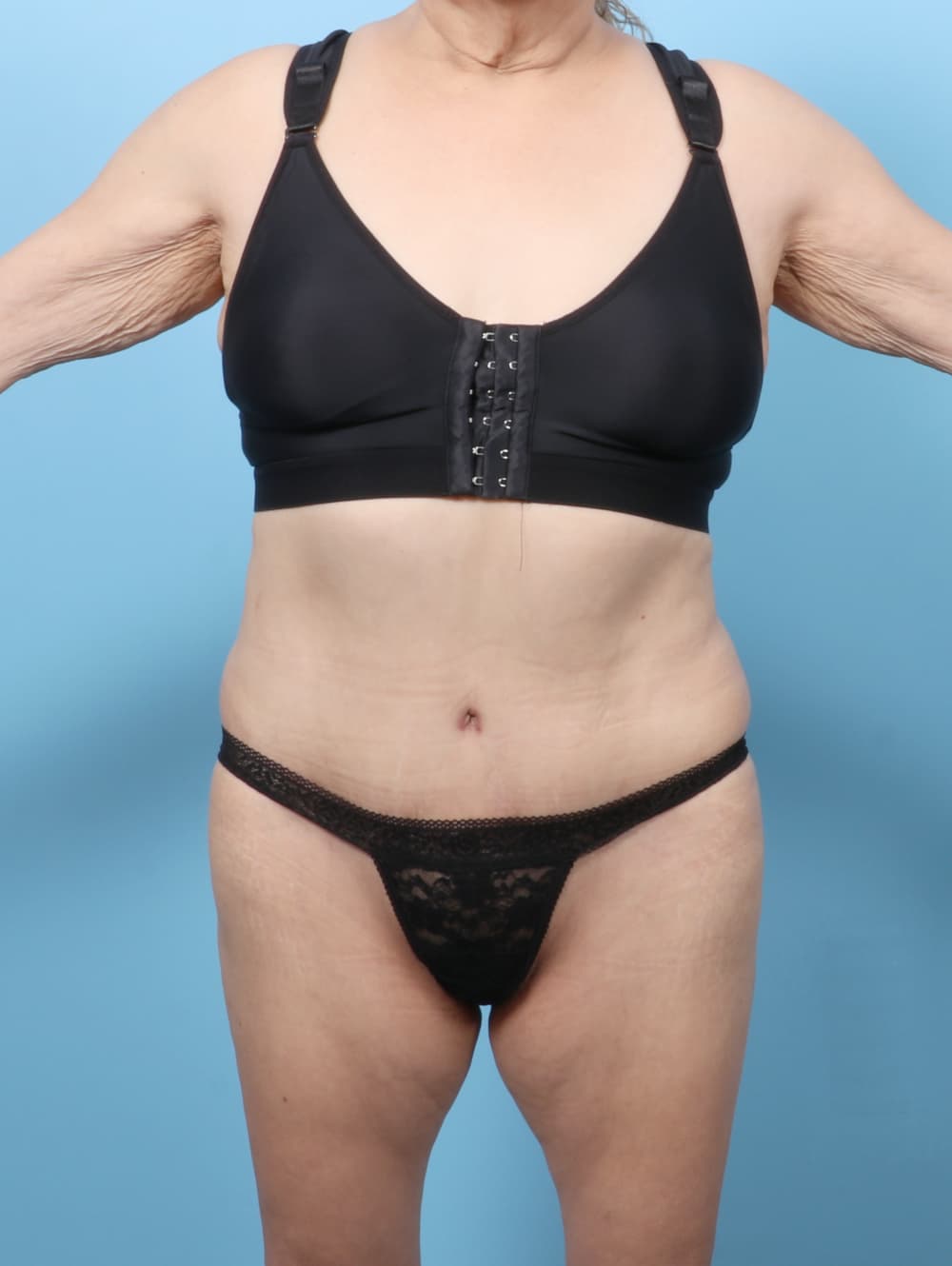 Body Contouring case #8245 after