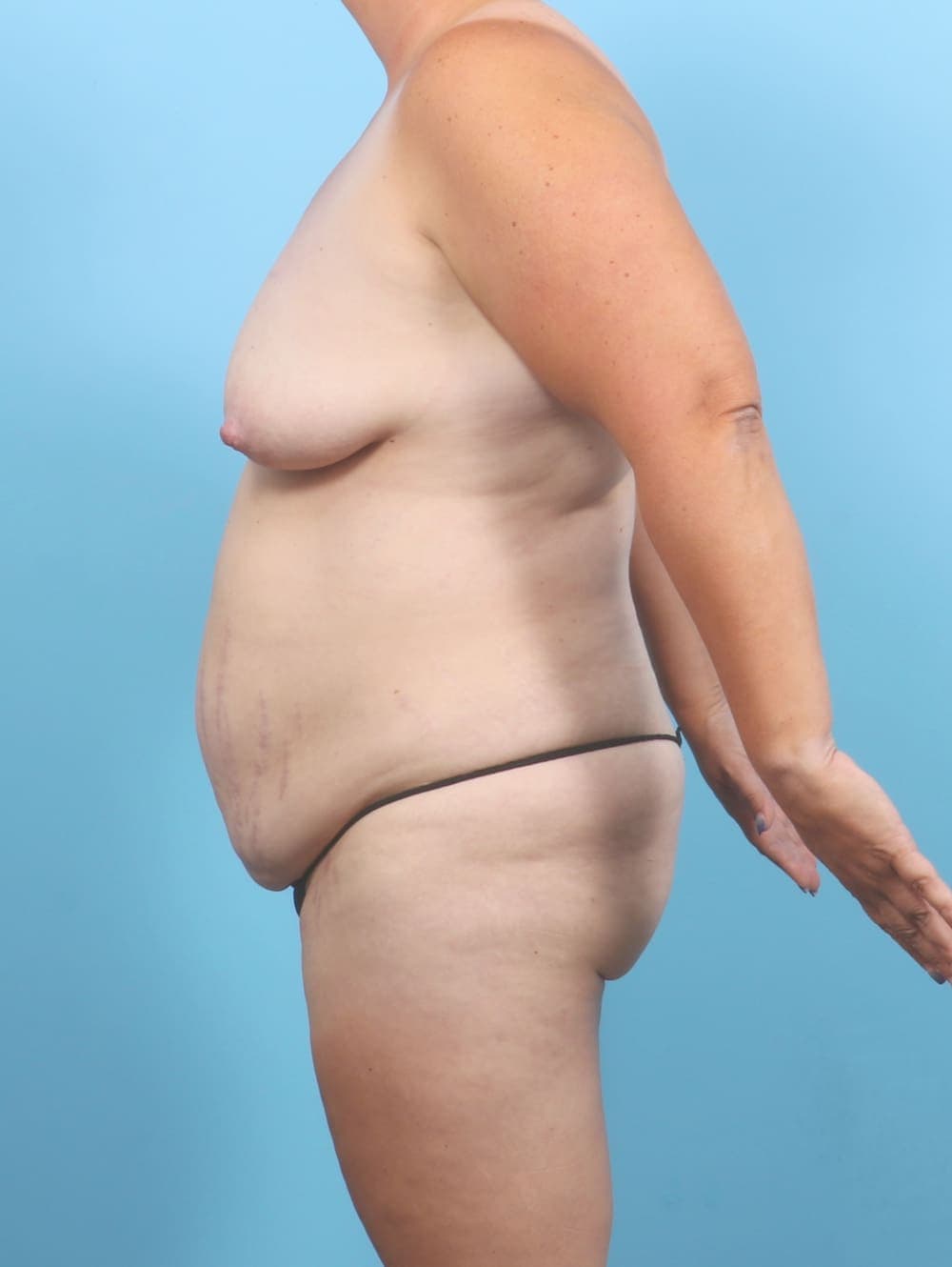Breast Lift/Reduction case #6707 before, image 3