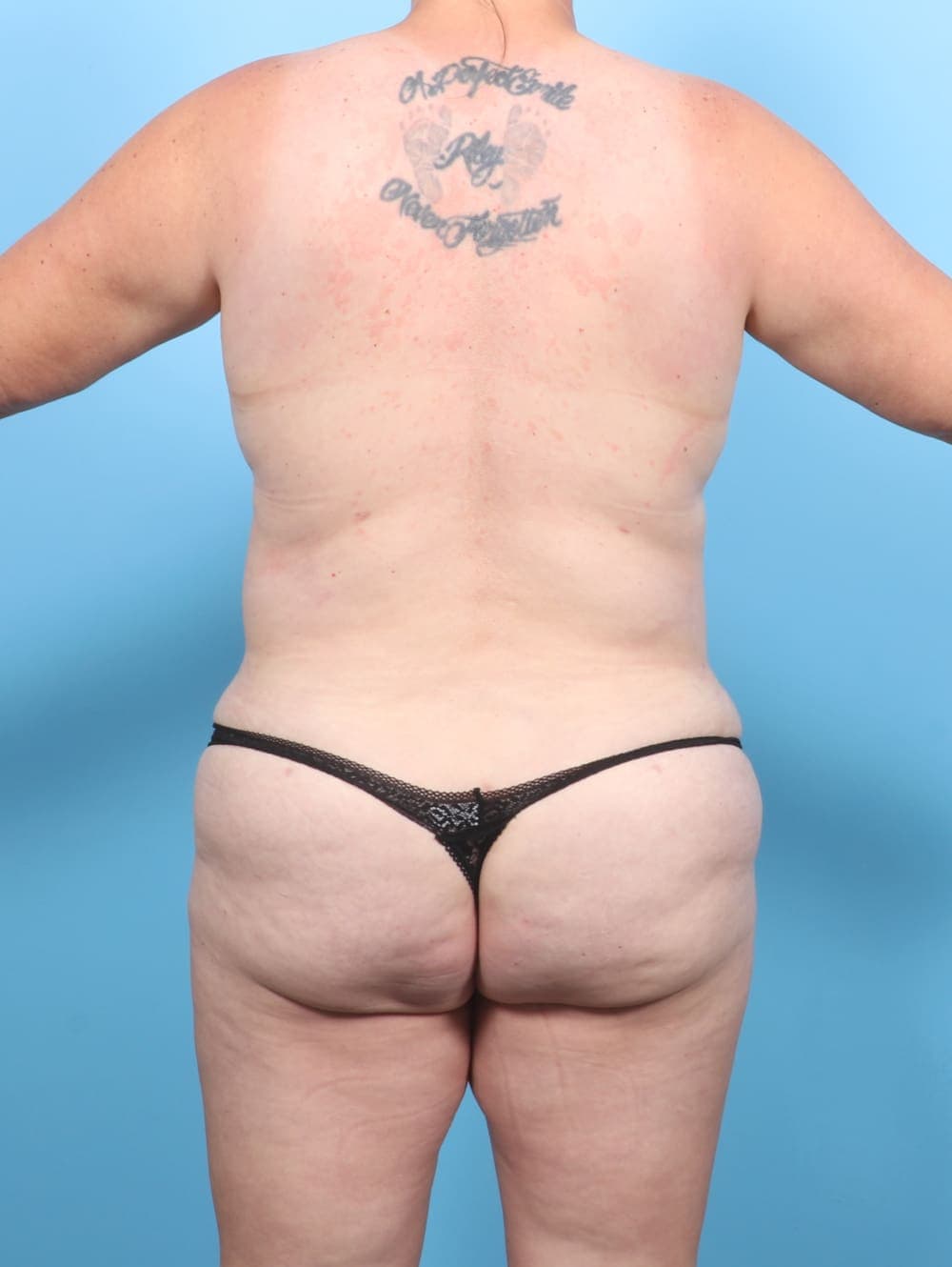 Breast Lift/Reduction case #6707 after, image 4