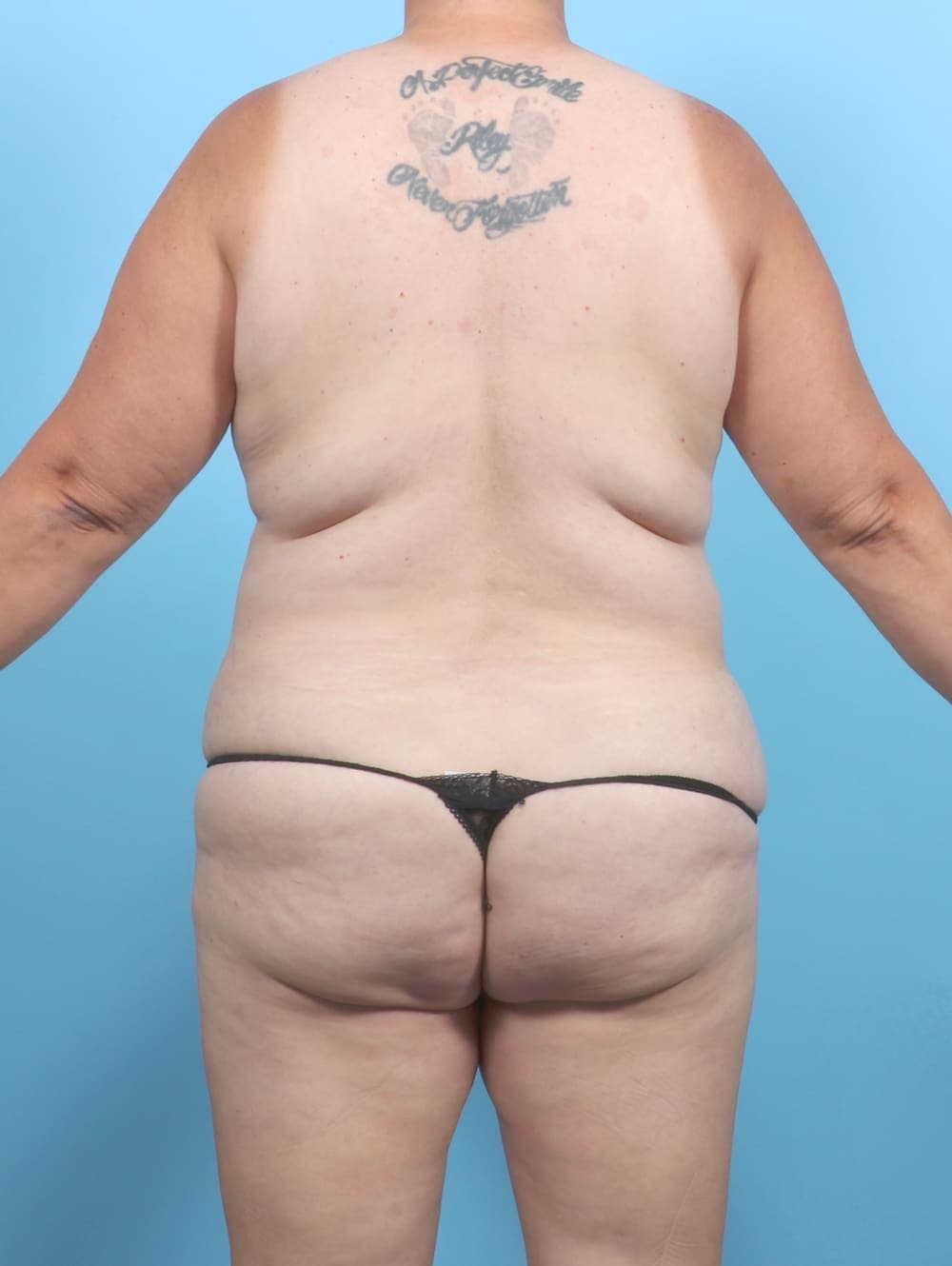 Breast Lift/Reduction case #6707 before, image 4