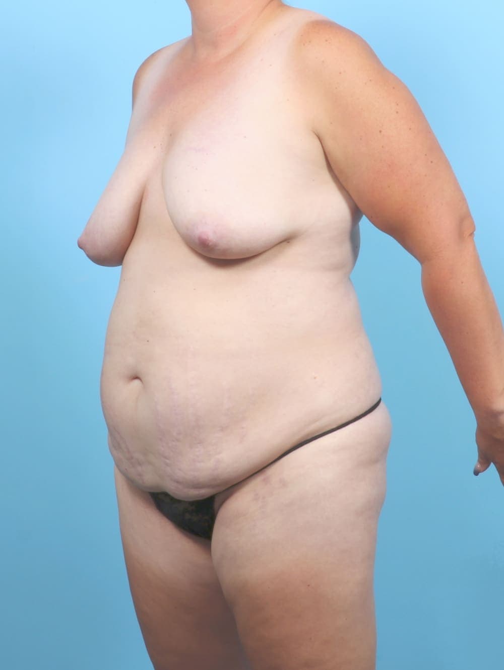 Breast Lift/Reduction case #6707 before, image 2