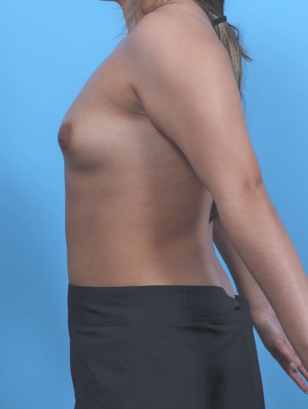 Breast Augmentation case #5968 before, image 3