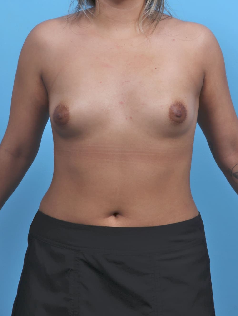 Breast Augmentation case #5968 before