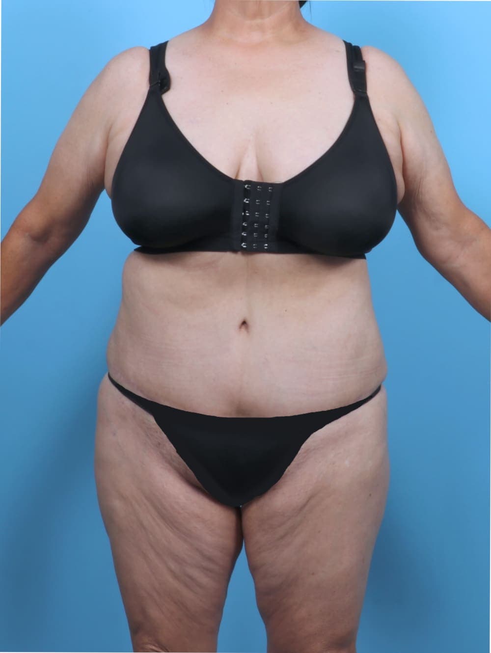 Liposuction case #5763 after