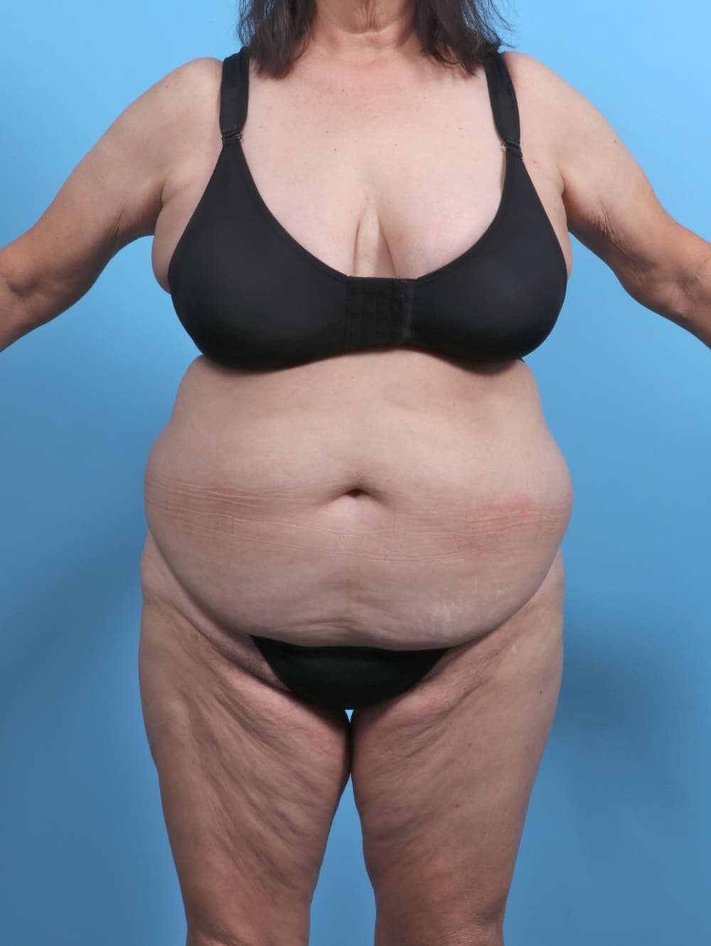 Liposuction case #5763 before