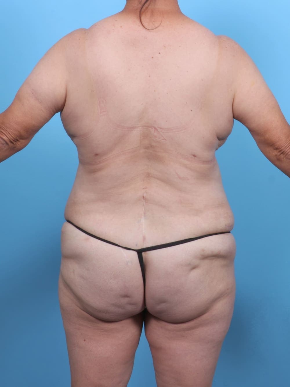 Liposuction case #5763 after, image 4