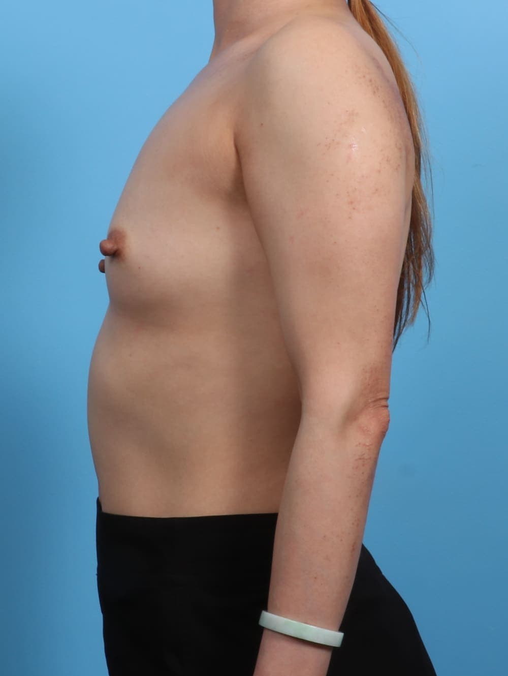 Breast Augmentation case #3779 before, image 3