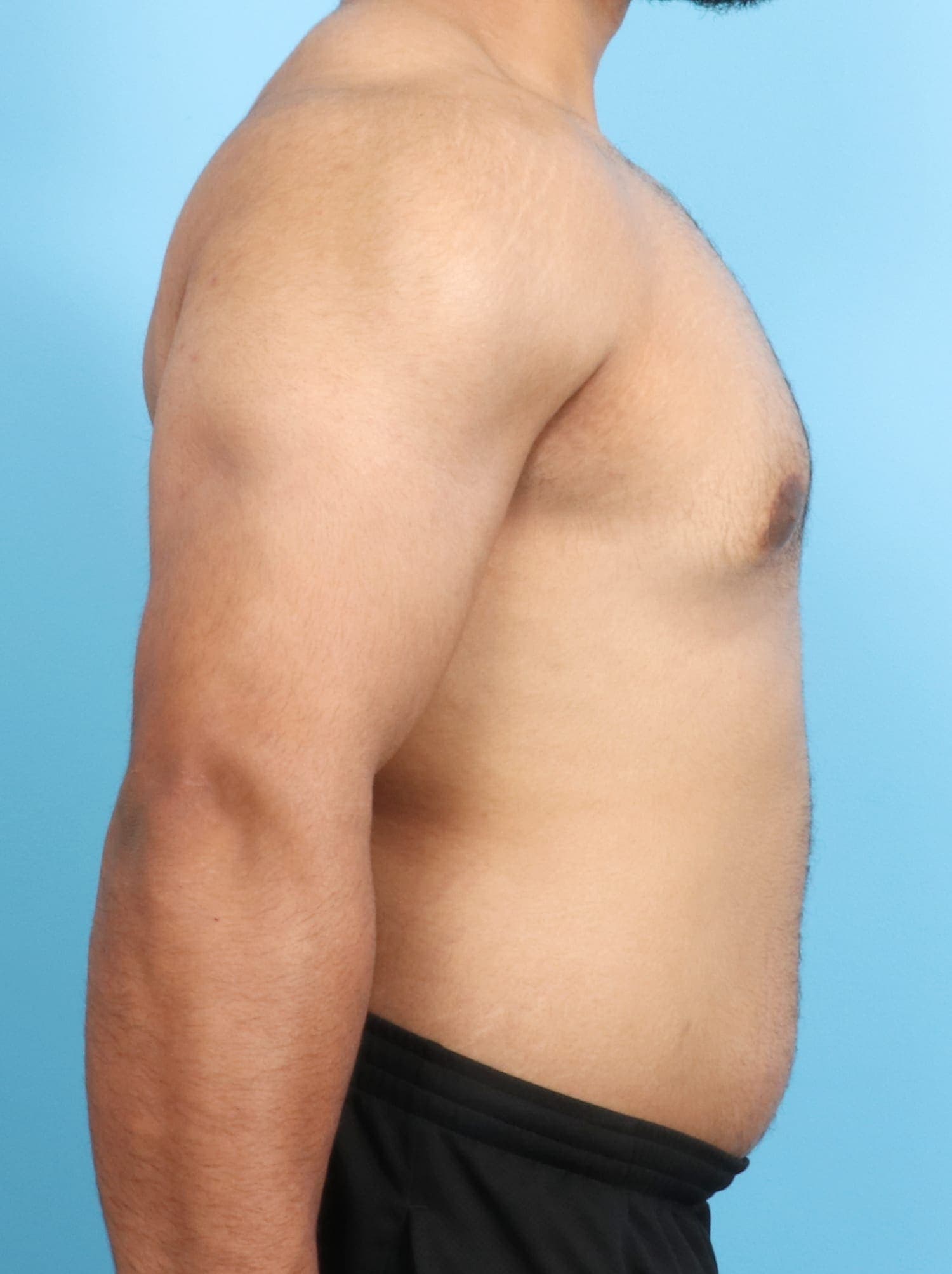 Male Breast Reduction case #1684 after, image 2