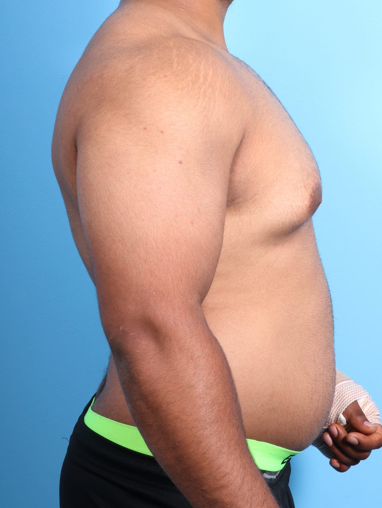 Male Breast Reduction case #1684 before, image 2