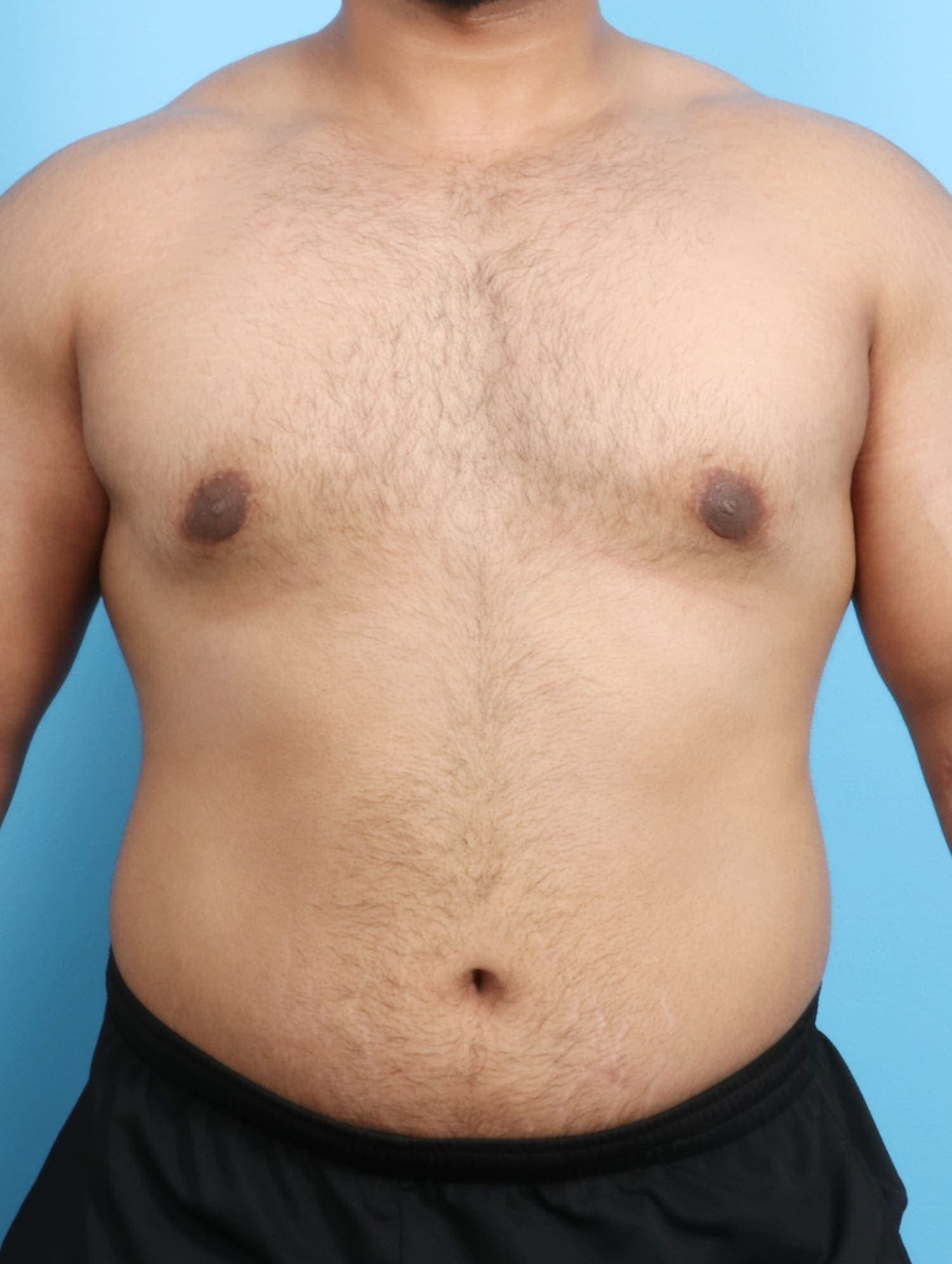 Male Breast Reduction case #1684 after, image 1