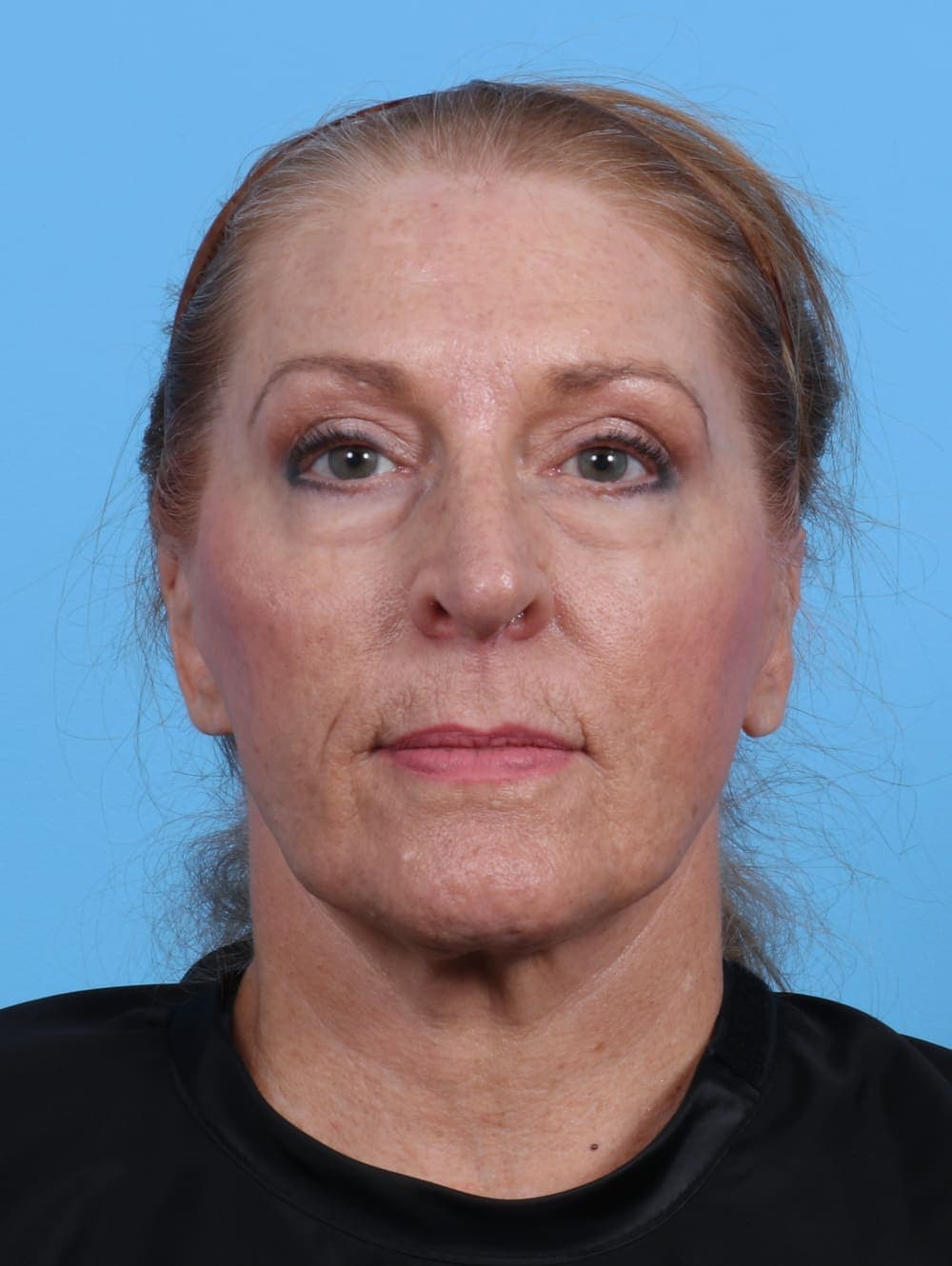 Facelift case #3641 after, image 1
