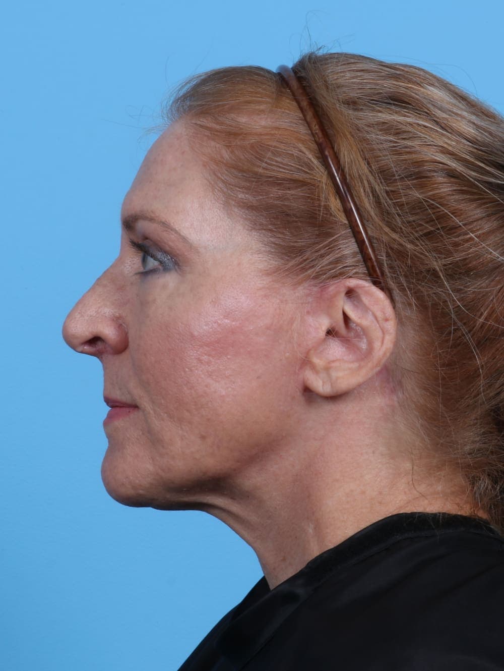 Facelift case #3641 after, image 3