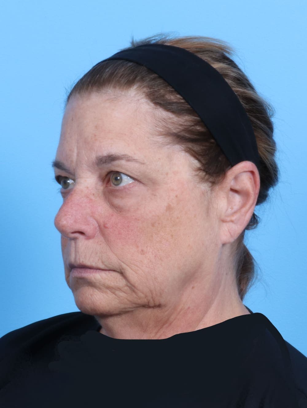 Facelift case #1973 before, image 2