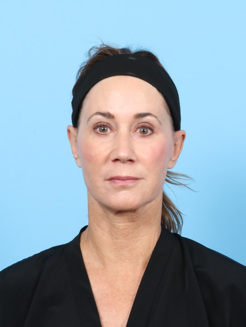 Facial Surgery case #7313 after
