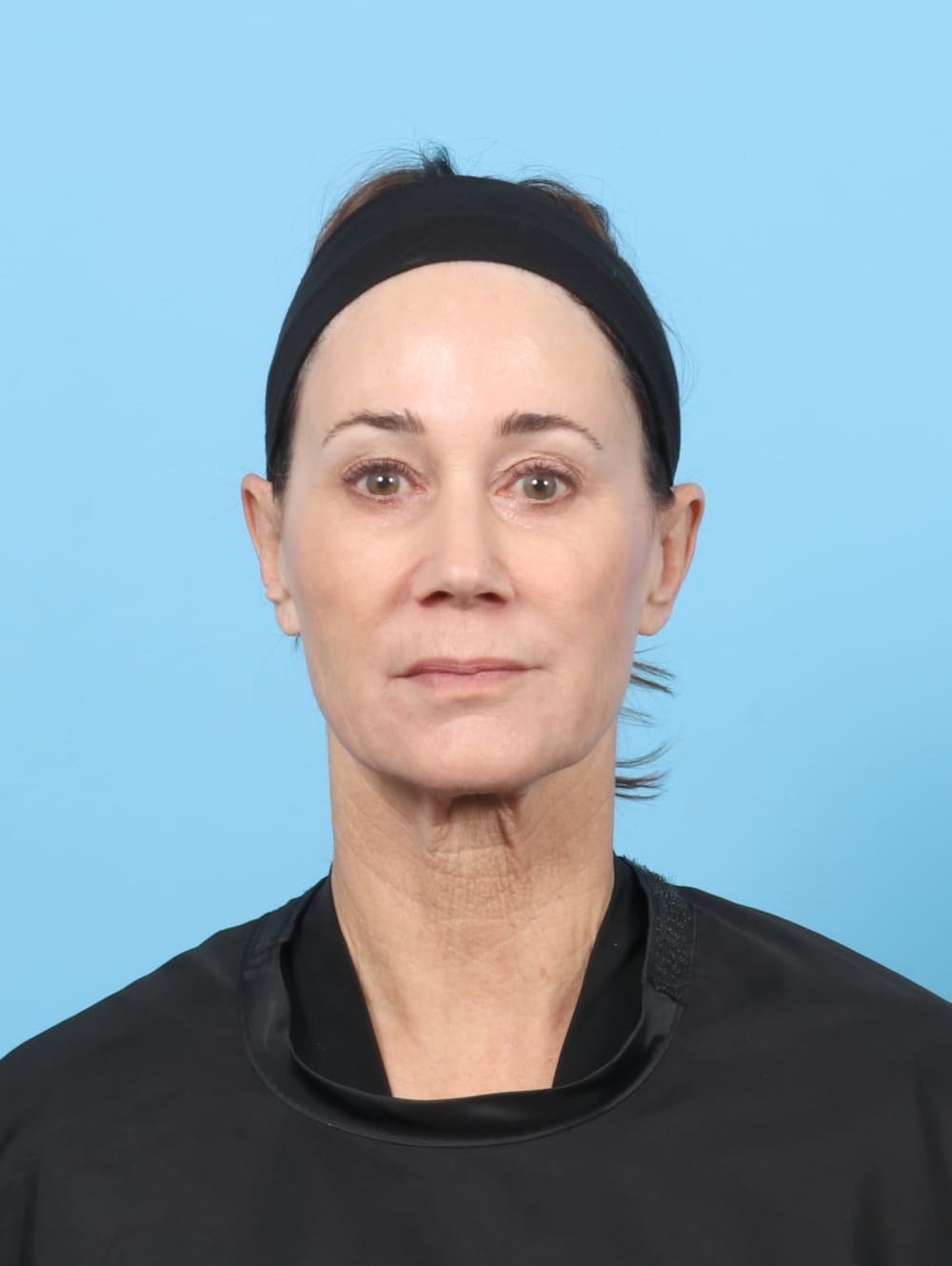Facial Surgery case #7313 before