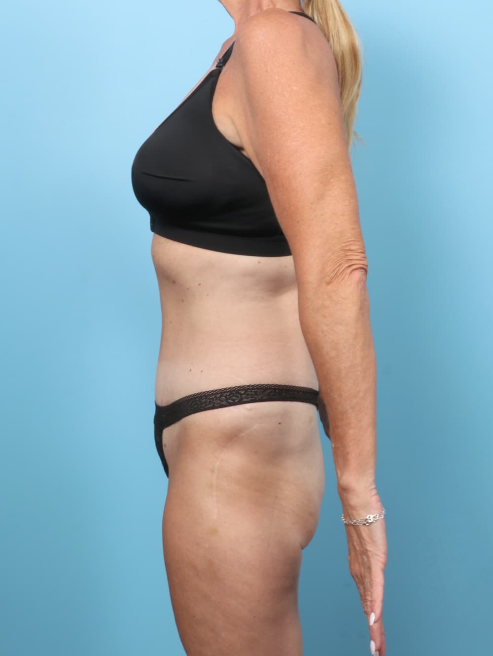 Tummy Tuck case #8378 after, image 3