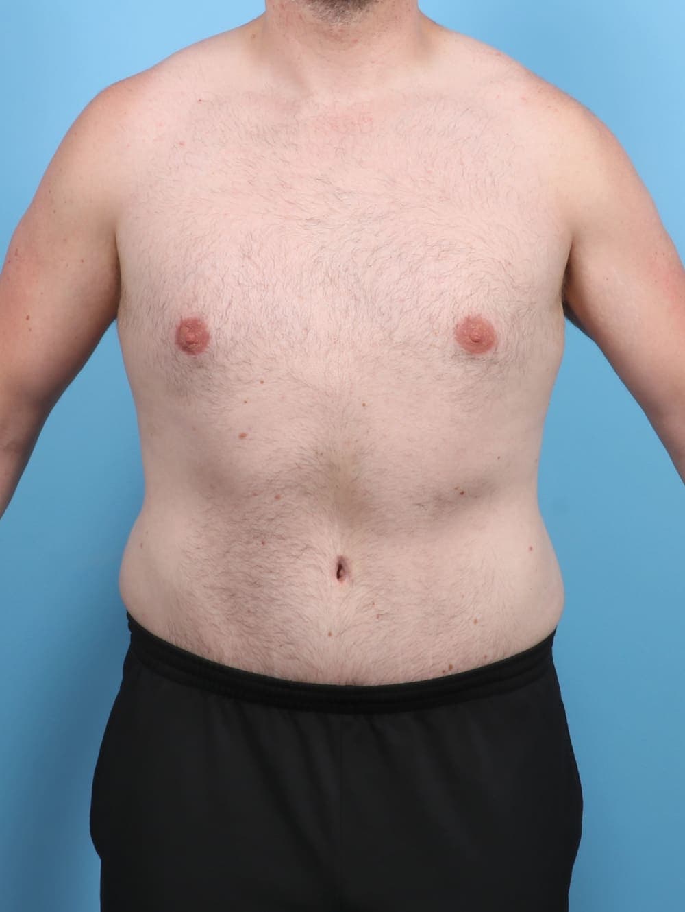 Liposuction case #5542 after