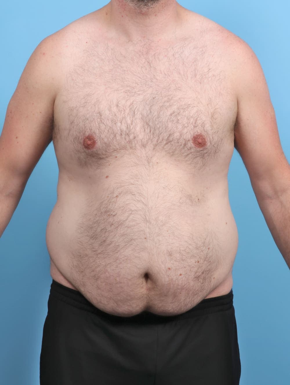 Liposuction case #5542 before