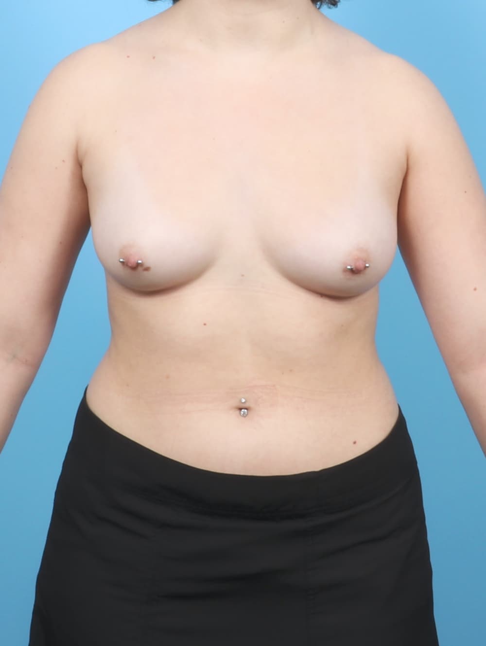 Breast Augmentation case #7070 before
