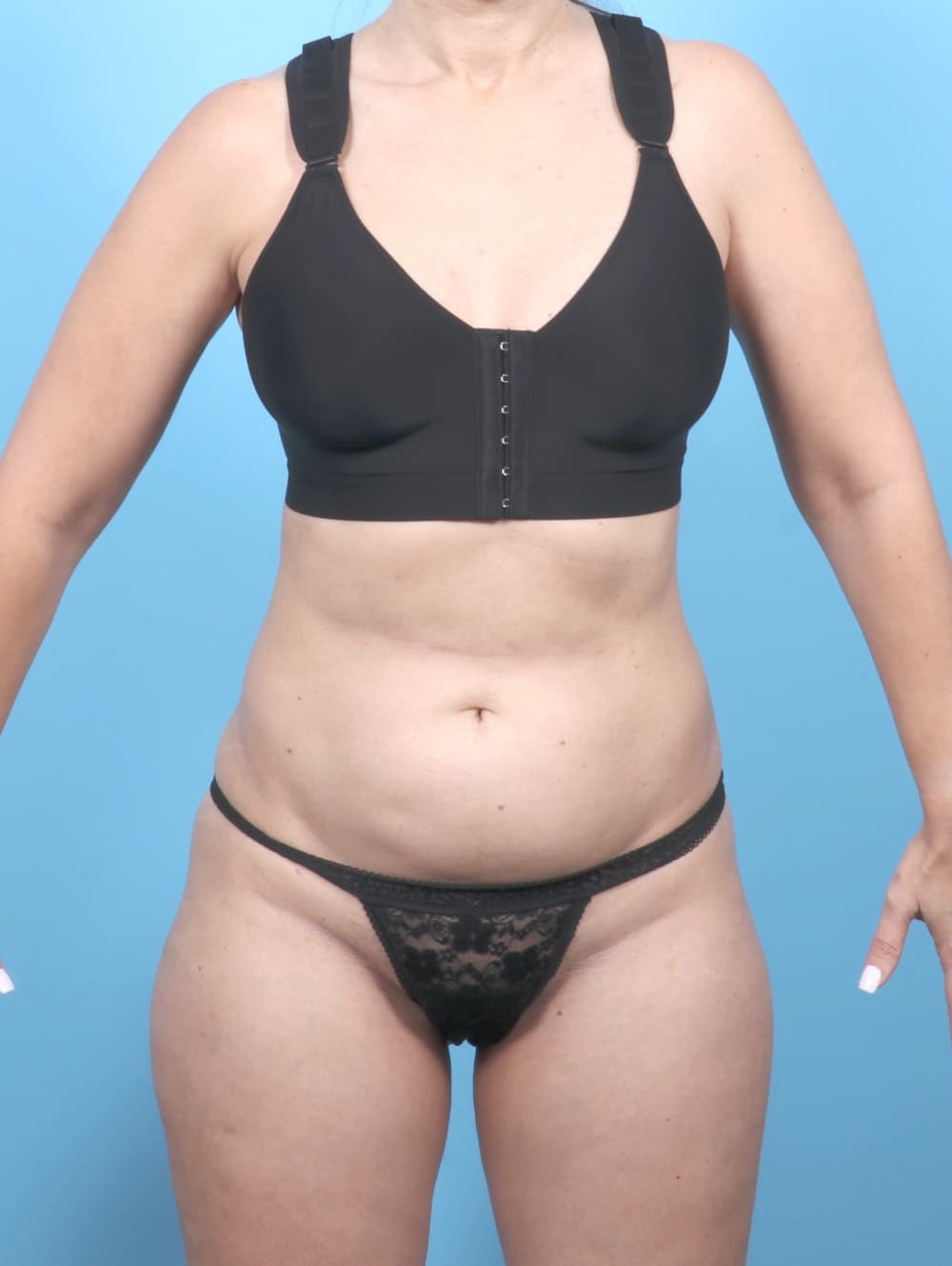 Tummy Tuck case #7054 before