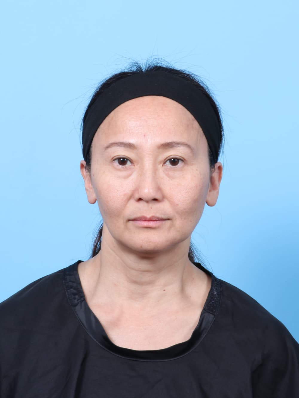Eyelid Surgery case #7944 after, image 1
