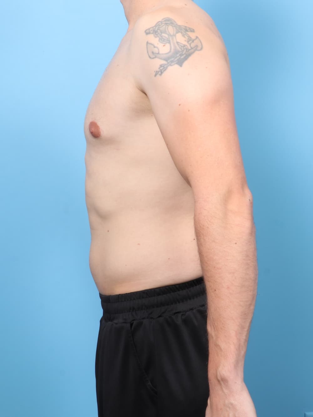 Male Breast Reduction case #8822 after, image 3