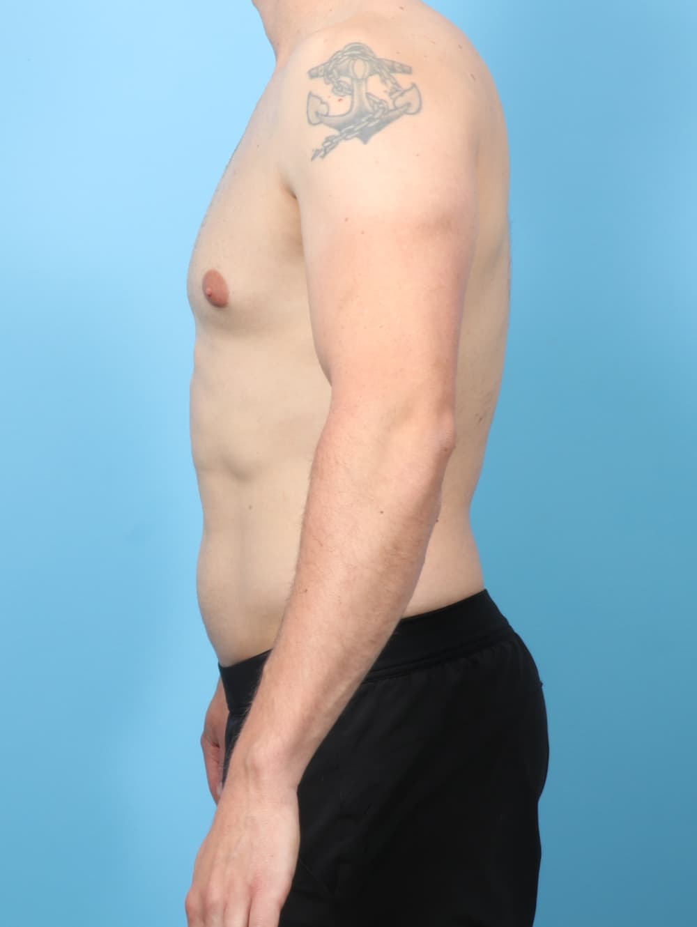 Male Breast Reduction case #8822 before, image 3