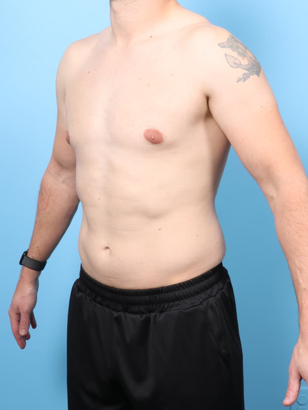 Male Breast Reduction case #8822 after, image 2