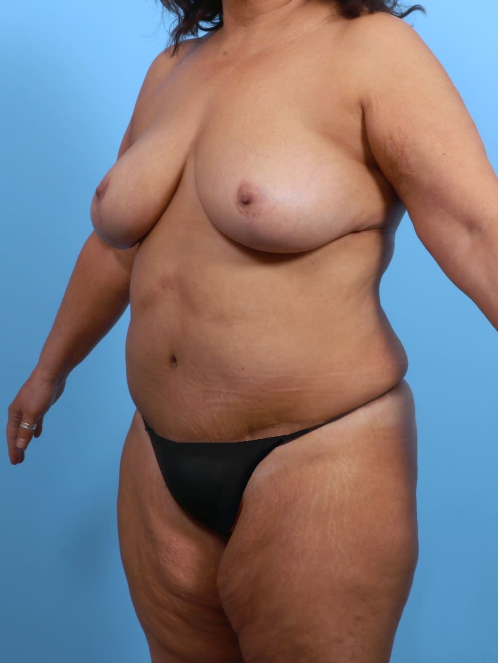 Tummy Tuck case #3407 after, image 2