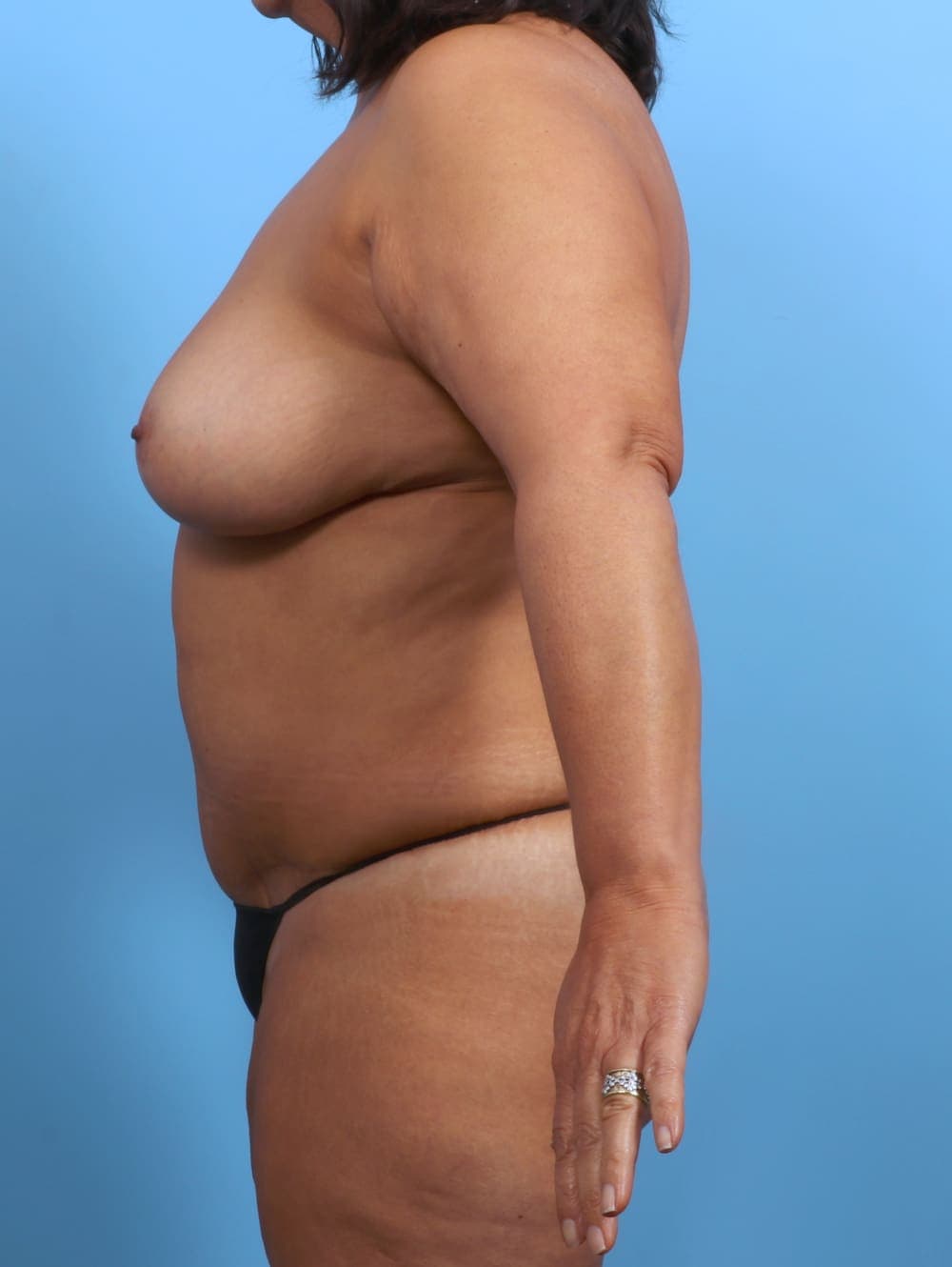 Tummy Tuck case #3407 after, image 3