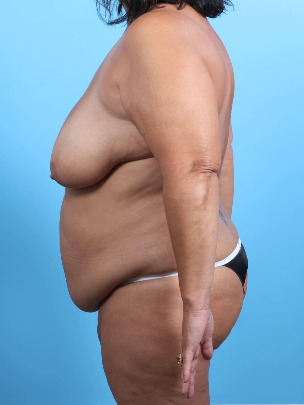 Tummy Tuck case #3407 before, image 3