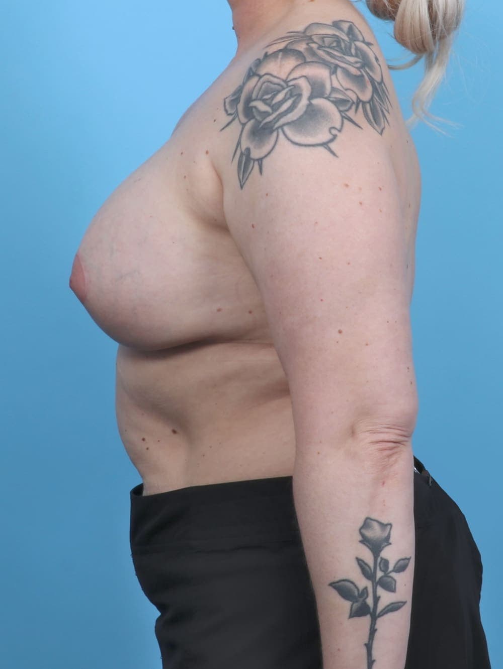 Breast Implant Revision case #5126 after, image 3
