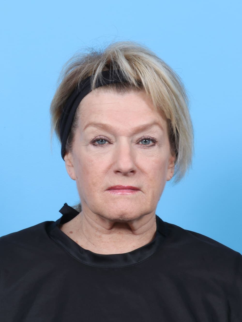 Eyelid Surgery case #6269 after