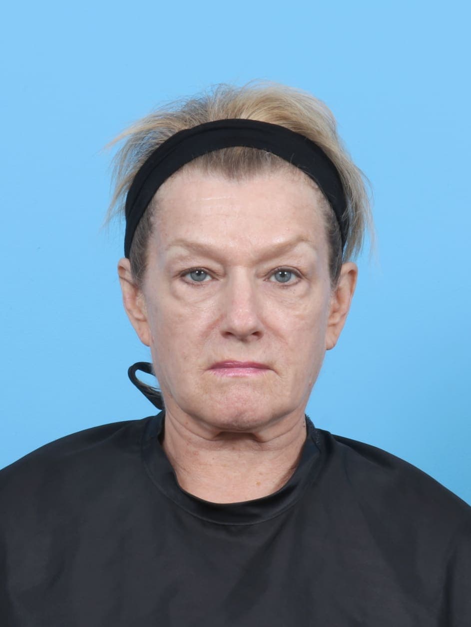 Eyelid Surgery case #6269 before