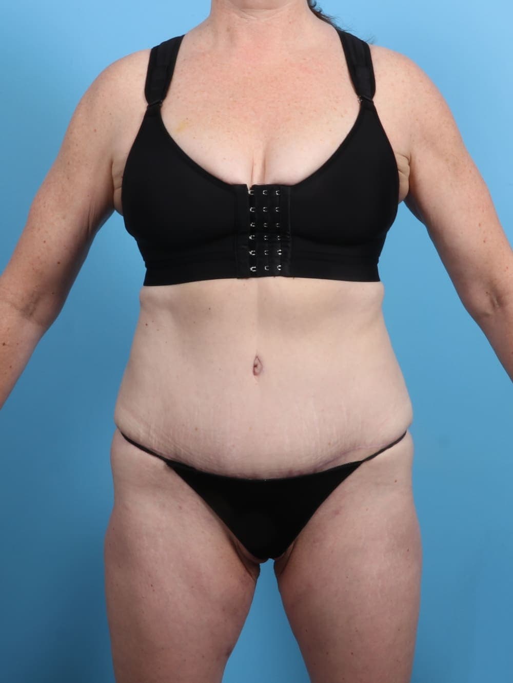Tummy Tuck case #3415 after, image 1