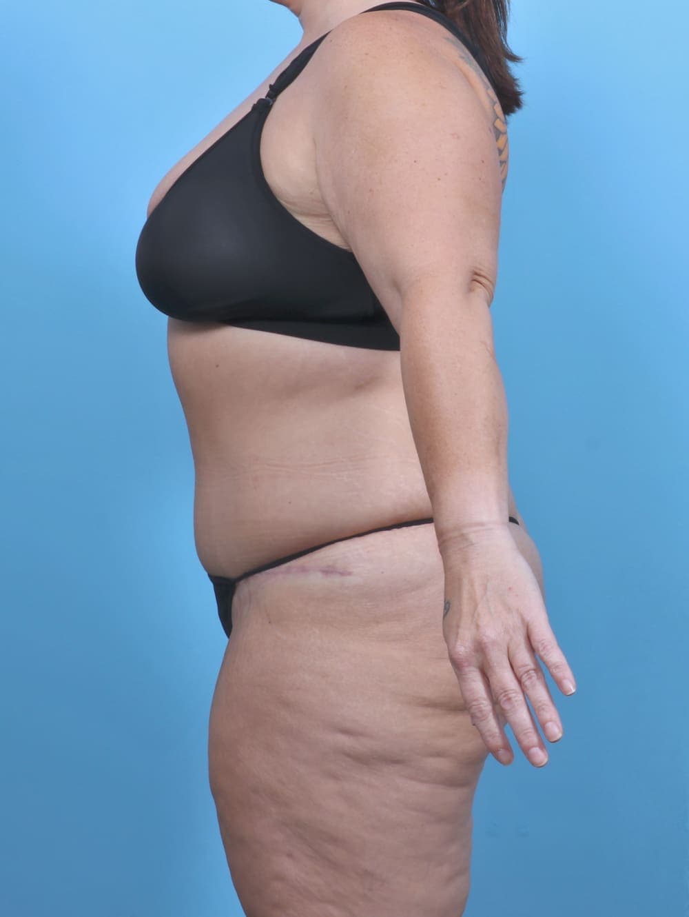 Tummy Tuck case #5789 after, image 3