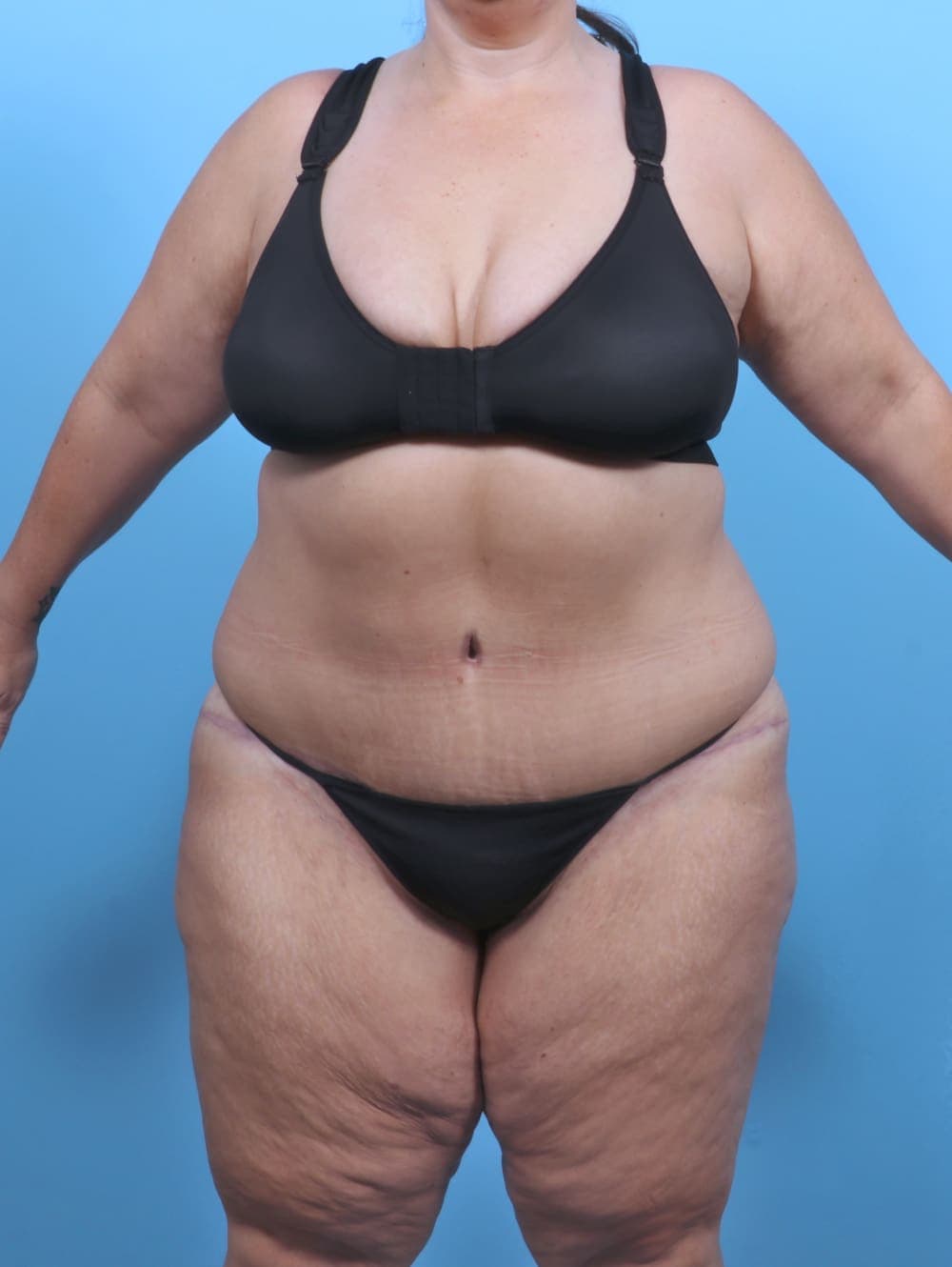 Tummy Tuck case #5789 after, image 1