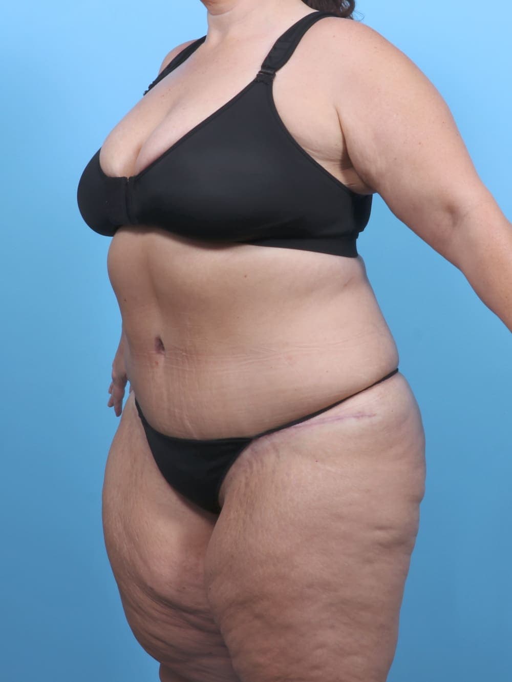 Tummy Tuck case #5789 after, image 2